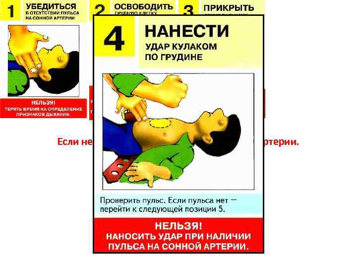 Внезапная смерть. Если нет сознания и нет пульса на сонной артерии. 