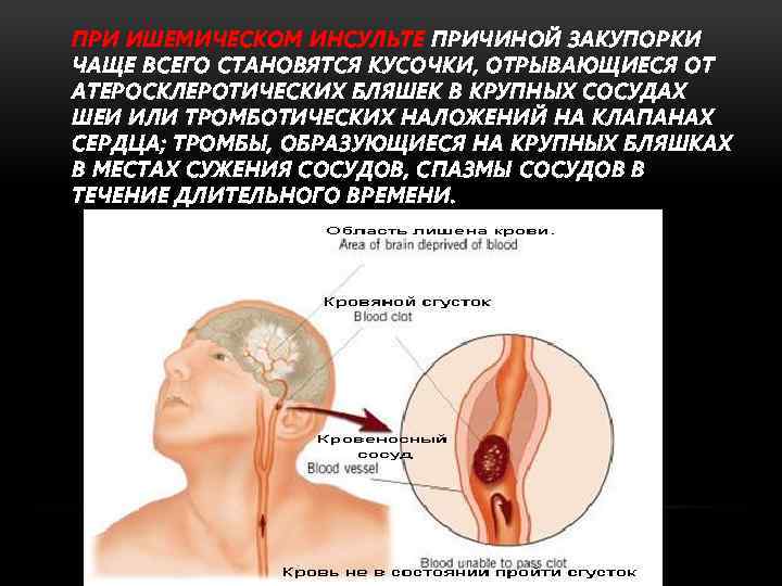 ПРИ ИШЕМИЧЕСКОМ ИНСУЛЬТЕ ПРИЧИНОЙ ЗАКУПОРКИ ЧАЩЕ ВСЕГО СТАНОВЯТСЯ КУСОЧКИ, ОТРЫВАЮЩИЕСЯ ОТ АТЕРОСКЛЕРОТИЧЕСКИХ БЛЯШЕК В