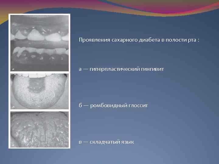 Проявления сахарного диабета в полости рта : а — гиперпластический гингивит б — ромбовидный