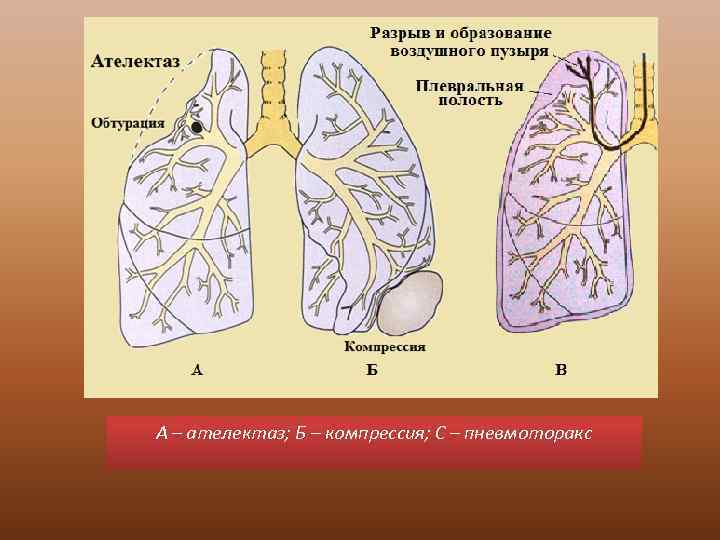 А – ателектаз; Б – компрессия; С – пневмоторакс 