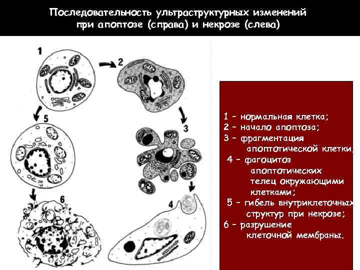 Последовательность ультраструктурных изменений при апоптозе (справа) и некрозе (слева) 1 – нормальная клетка; 2