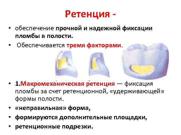 Ретенирование зуба. Ретенционная форма полости. Инструменты для пломбирования кариозных полостей амальгамой.