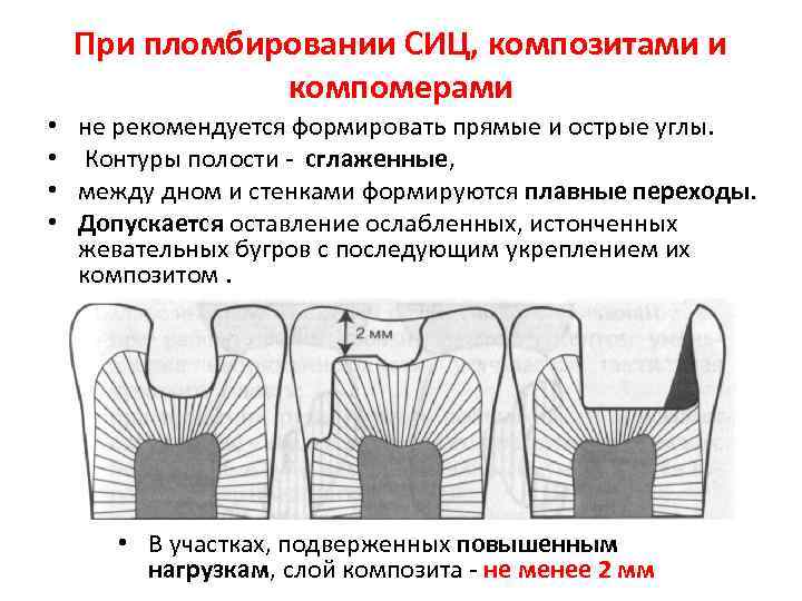 Пломбирование кариозных полостей временных. Этапы пломбирования временных зубов стеклоиономерными цементами. Пломбирование кариозной полости 2 класса композиционным материалом. Пломбирование кариозных полостей 1 класса композиционным материалом. Пломбирование полостей i класса композиционными материалами.