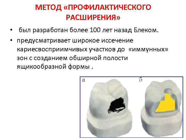 Способ расширения. Метод профилактического расширения кариозной полости. Методы расширения кариозной полости. Профилактическое расширение кариозной полости. Превентивное расширение кариозной полости.