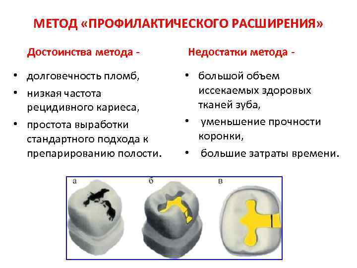 Способы препарирования кариозных полостей. Метод профилактического расширения кариозной полости. Метод профилактического расширения по Блэку. Методы расширения кариозной полости. Метод профилактического расширения кариозной полости предложил.