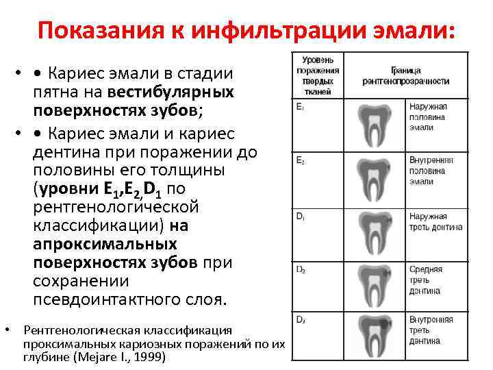 План лечения кариеса пример