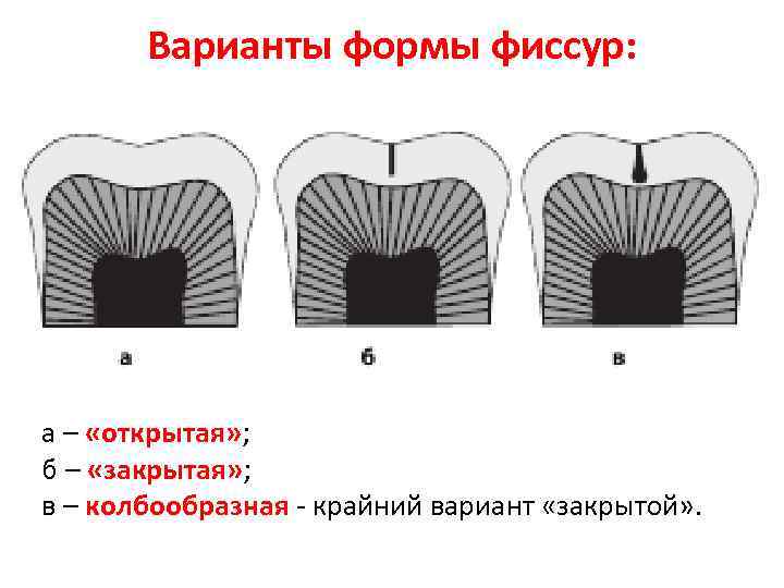 Открытые и закрытые поверхности. Строение и форма фиссур.