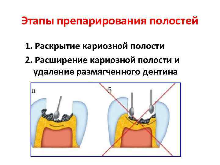 Способы препарирования кариозных полостей