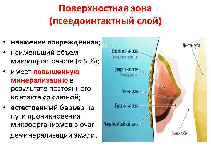 План лечения поверхностного кариеса