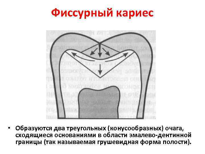 Эмалево дентинной. Поверхностный фиссурный кариес. Кариес на фиссурах зубов. Фиссурный (окклюзионный) кариес.