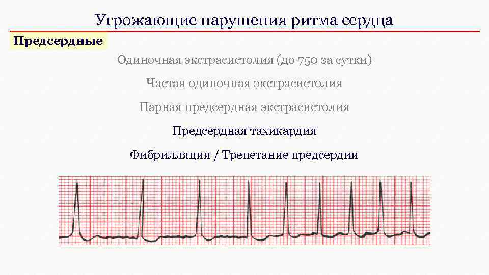 Что такое экстрасистолия сердца. Экстрасистолы и фибрилляция предсердий. Предсердная экстрасистолия пульс. Парная предсердная экстрасистолия. Фибрилляция предсердий и желудочковая экстрасистолия.