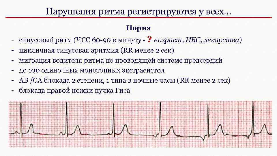 Нарушения ритма регистрируются у всех… Норма - синусовый ритм (ЧСС 60 -90 в минуту