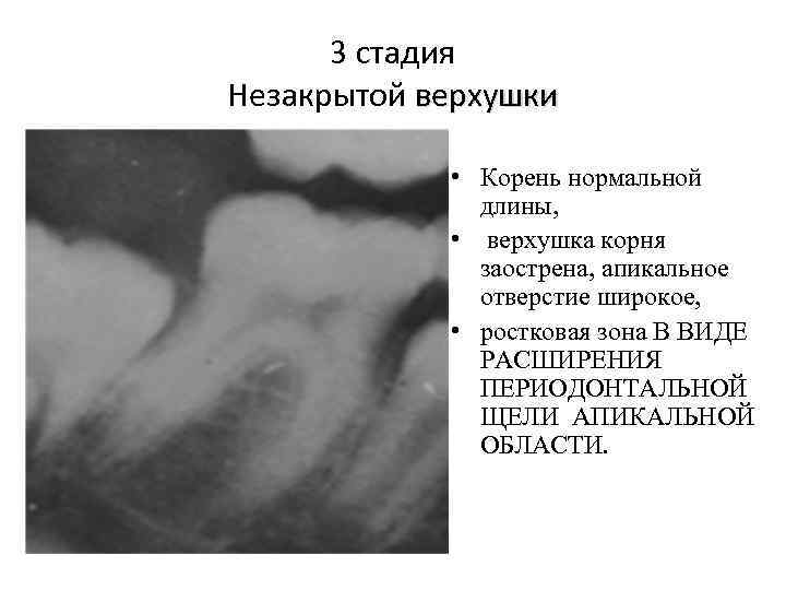 Несформированные корни периодонтит лечение