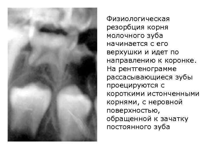 Физиологическая резорбция корня молочного зуба начинается с его верхушки и идет по направлению к