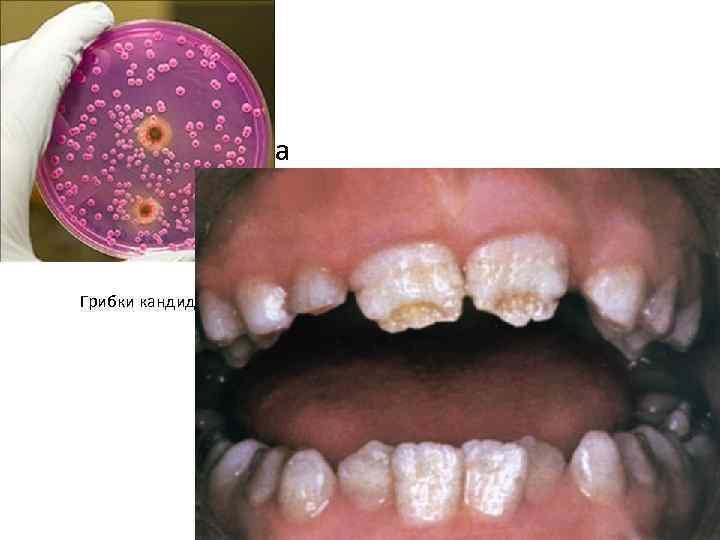  • Грибки кандида 