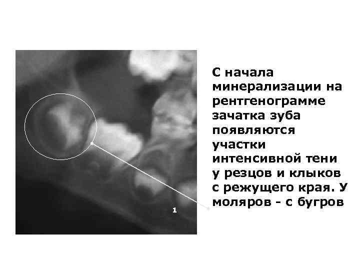 1 С начала минерализации на рентгенограмме зачатка зуба появляются участки интенсивной тени у резцов