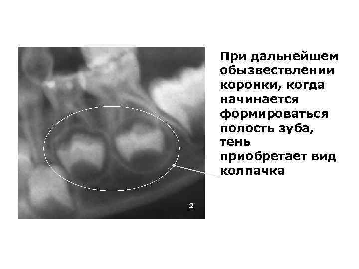 При дальнейшем обызвествлении коронки, когда начинается формироваться полость зуба, тень приобретает вид колпачка 2