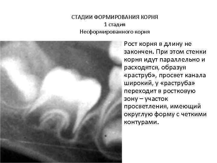 Рентгенологическая картина зубов и их зачатков на различных этапах формирования