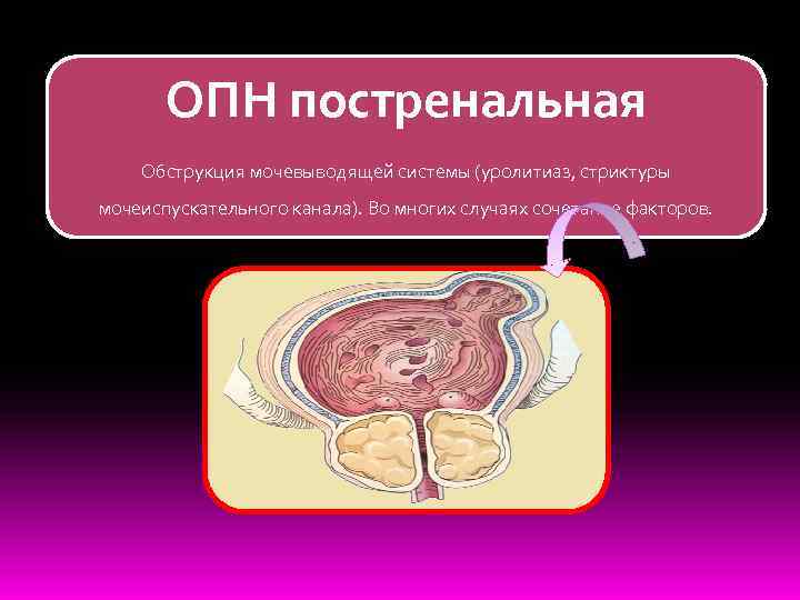   ОПН постренальная Обструкция мочевыводящей системы (уролитиаз, стриктуры мочеиспускательного канала). Во многих случаях