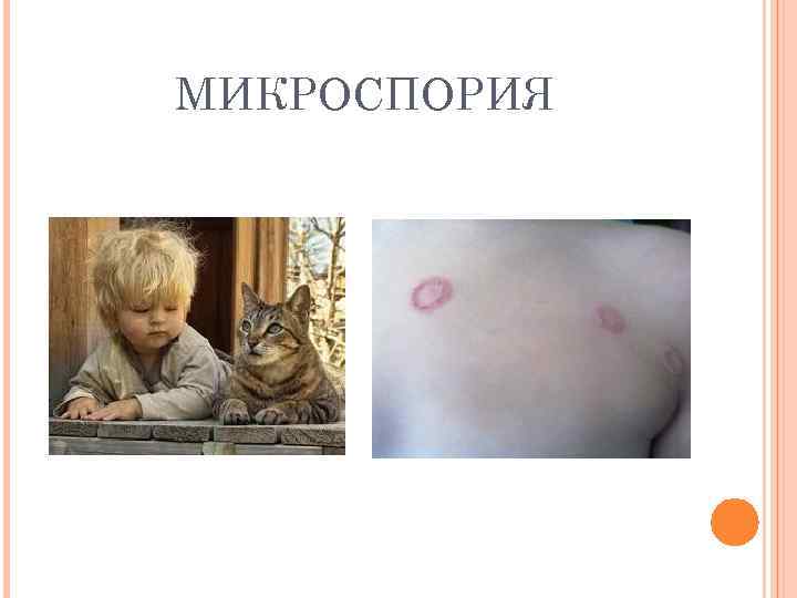 МИКРОСПОРИЯ 