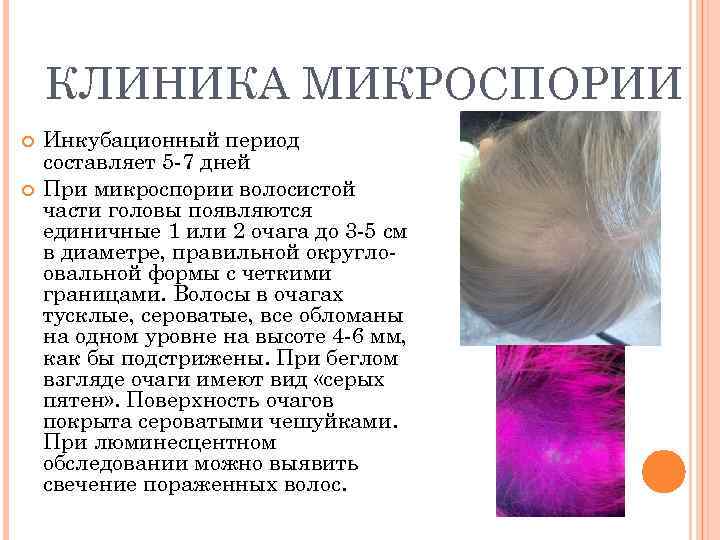   КЛИНИКА МИКРОСПОРИИ Инкубационный период составляет 5 -7 дней При микроспории волосистой части