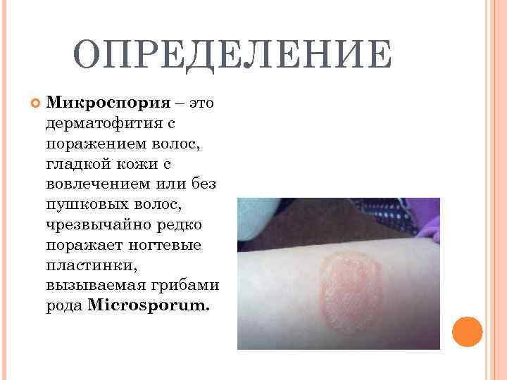  ОПРЕДЕЛЕНИЕ Микроспория – это дерматофития с поражением волос, гладкой кожи с вовлечением или
