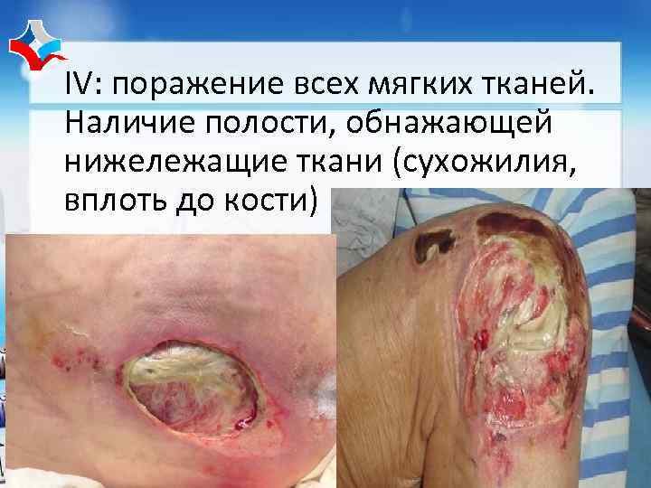 IV: поражение всех мягких тканей. Наличие полости, обнажающей нижележащие ткани (сухожилия, вплоть до кости)