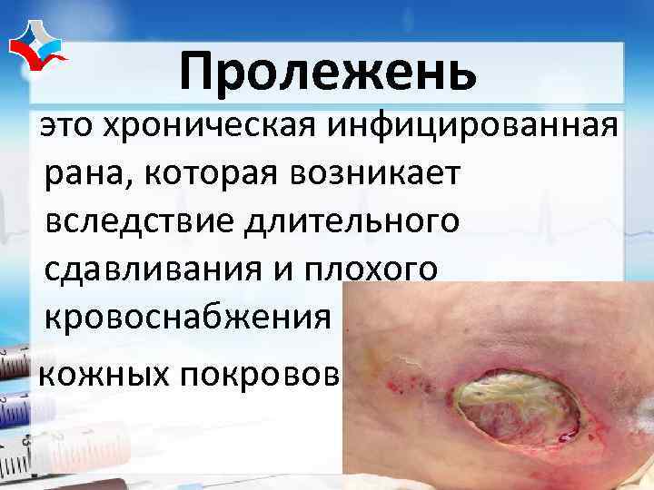   Пролежень это хроническая инфицированная рана, которая возникает вследствие длительного сдавливания и плохого