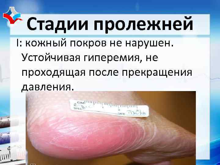  Стадии пролежней I: кожный покров не нарушен.  Устойчивая гиперемия, не  проходящая