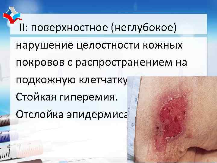 II: поверхностное (неглубокое) нарушение целостности кожных покровов с распространением на подкожную клетчатку. Стойкая гиперемия.