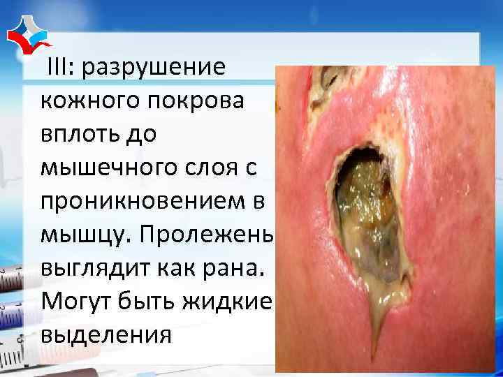 III: разрушение кожного покрова вплоть до мышечного слоя с проникновением в мышцу. Пролежень выглядит