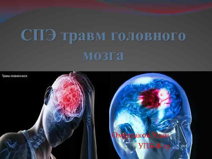 СПЭ травм головного  мозга   Омурзаков Улан   УПБ-8 -13 