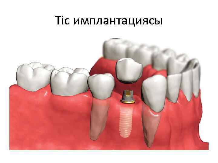 Тіс имплантациясы 