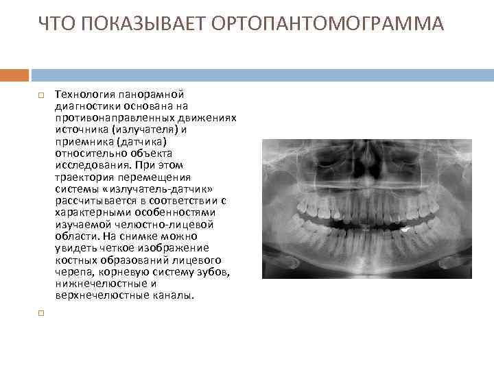 ЧТО ПОКАЗЫВАЕТ ОРТОПАНТОМОГРАММА  Технология панорамной диагностики основана на противонаправленных движениях источника (излучателя) и