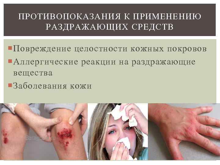  ПРОТИВОПОКАЗАНИЯ К ПРИМЕНЕНИЮ  РАЗДРАЖАЮЩИХ СРЕДСТВ  Повреждение целостности кожных покровов  Аллергические