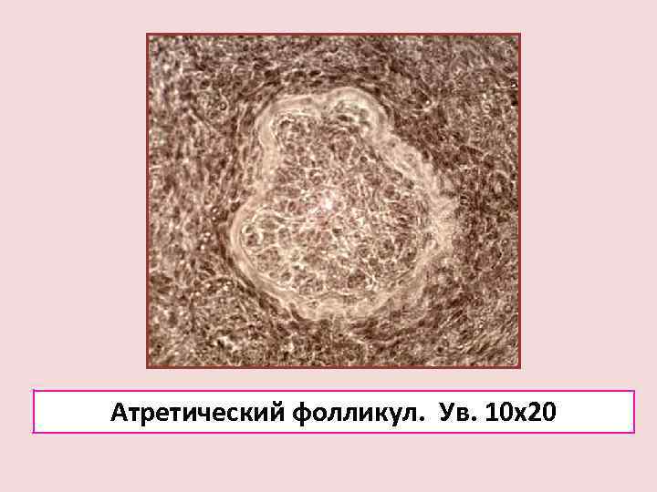 Атретический фолликул. Ув. 10 х20 