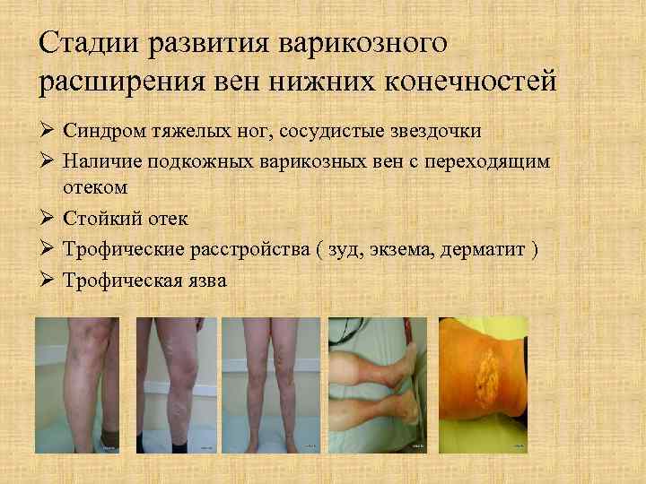 Стадии развития варикозного расширения вен нижних конечностей Ø Синдром тяжелых ног, сосудистые звездочки Ø