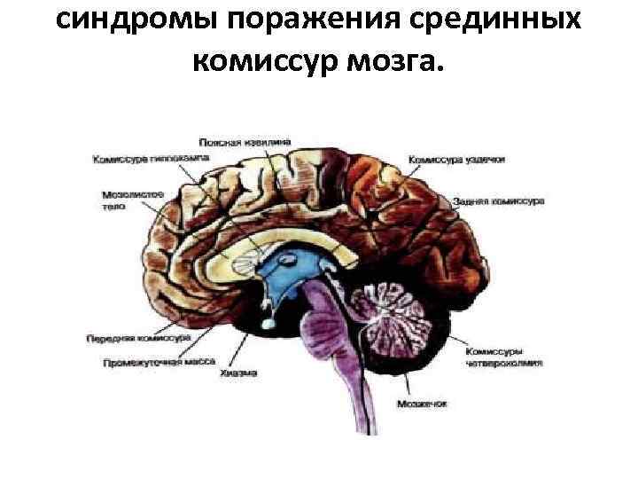 >синдромы поражения срединных   комиссур мозга. 