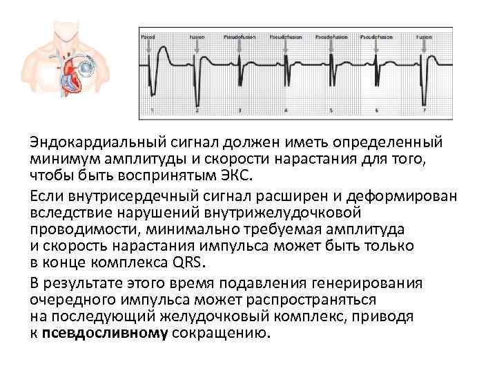 Сигнал должен. Скорость нарастания давления это. Эндокардиальный экс. Эндокардиальной электрокардиограммы. Нарушение чувствительности экс.