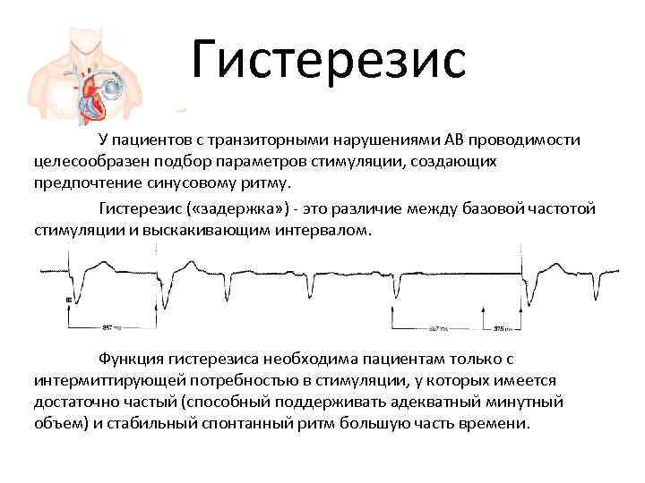     Гистерезис  У пациентов с транзиторными нарушениями АВ проводимости целесообразен
