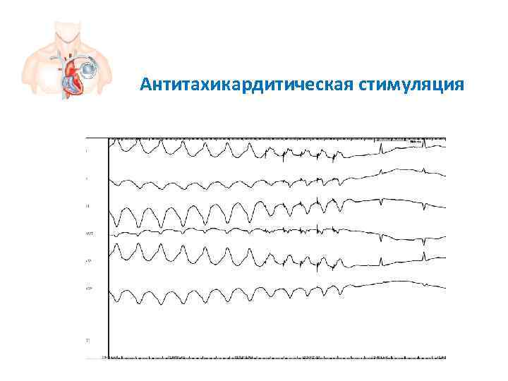Антитахикардитическая стимуляция 
