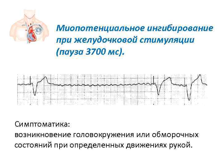    Миопотенциальное ингибирование   при желудочковой стимуляции   (пауза 3700