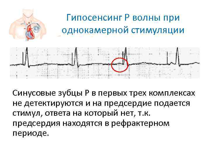   Гипосенсинг Р волны при   однокамерной стимуляции Синусовые зубцы Р в