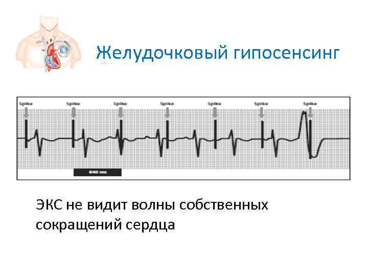   Желудочковый гипосенсинг ЭКС не видит волны собственных сокращений сердца 