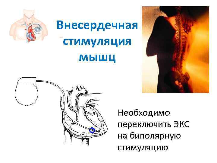 Внесердечная  стимуляция мышц   Необходимо  переключить ЭКС  на биполярную 