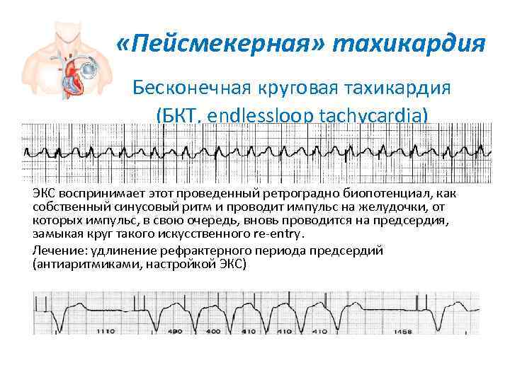 Желудочковая тахикардия карта вызова