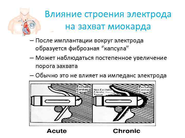   Влияние строения электрода   на захват миокарда – После имплантации вокруг