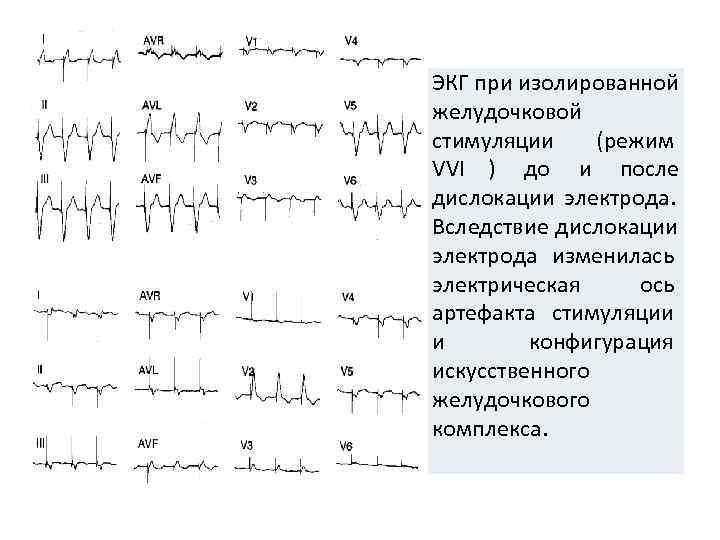 ЭКГ при изолированной желудочковой стимуляции (режим VVI ) до и после дислокации электрода. 