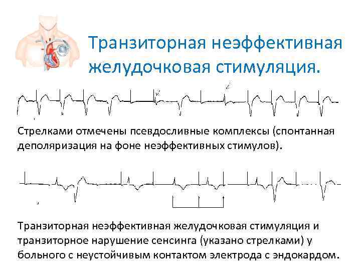   Транзиторная неэффективная   желудочковая стимуляция.  Стрелками отмечены псевдосливные комплексы (спонтанная
