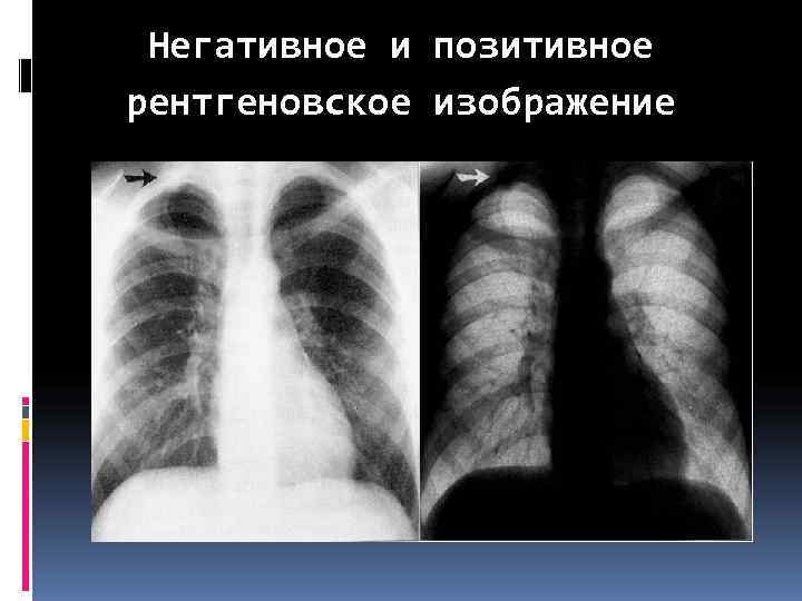  Негативное и позитивное рентгеновское изображение 